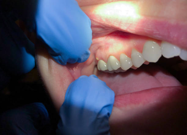 Best Urgent Care for Lost Fillings or Crowns in Mosinee, WI